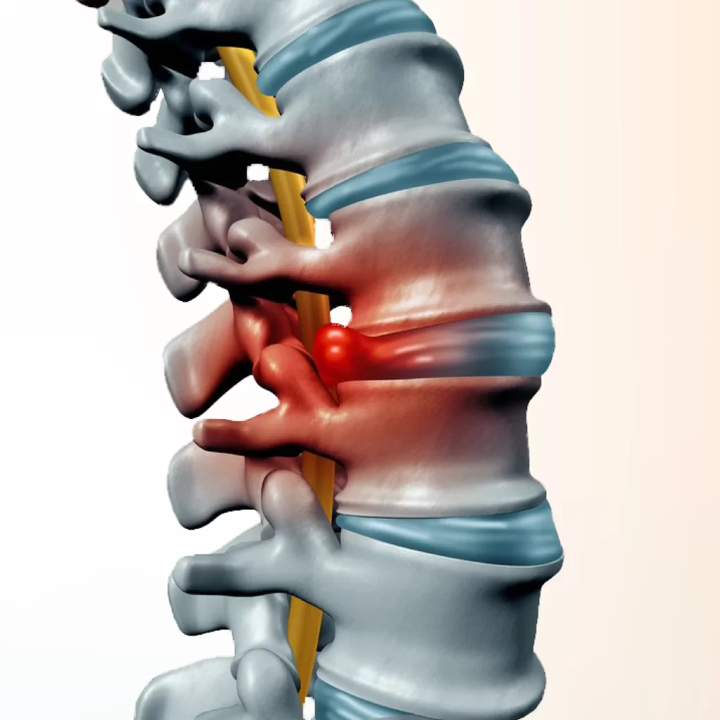 Herniated Disc Treatment