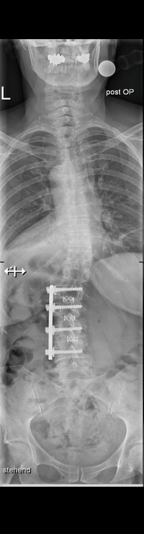 After treatment